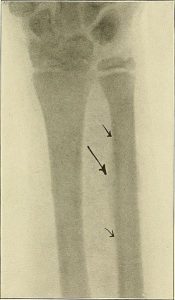 Practical_electro-therapeutics_and_X-ray_therapy_-_with_chapters_on_phototherapy_X-ray_in_eye_surgery_X-ray_in_dentistry_and_medico-legal_aspect_of_the_X-ray_1912_14754827864-175x300